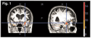 effet de la technique chiropratique émotionelle sur le cerveau