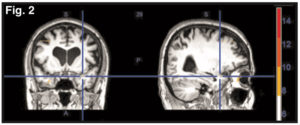 NET-chiropraxie-emotion-cerveau-stress